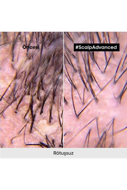 LOréal Professionnel Scalp Advanced Kepek Önleyici Şampuan - Saç Derisi Kaşıntı ve Pullanma Kontrolü 500 ml - 6